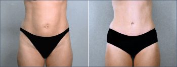 Classic Tummy Tuck Patient 5