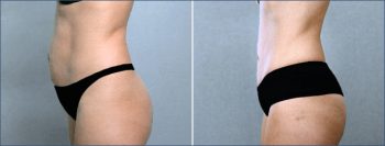 Classic Tummy Tuck Patient 5