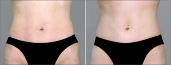 Classic Tummy Tuck Patient 19 (Classic Mini Tummy Tuck)