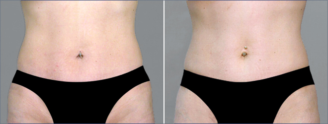 Classic Tummy Tuck Patient 19 (Classic Mini Tummy Tuck)