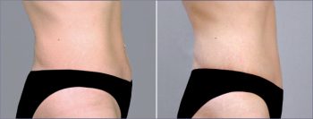 Classic Tummy Tuck Patient 19 (Classic Mini Tummy Tuck)