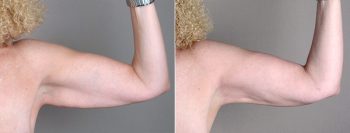 Upper Arm Rejuvenation Patient 5 – Arm Lift