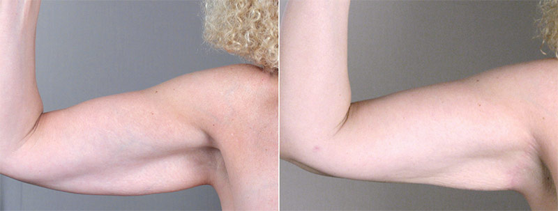 Upper Arm Rejuvenation Patient 5 – Arm Lift