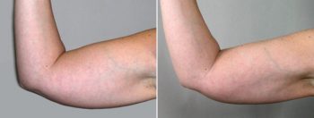 Upper Arm Rejuvenation Patient 1 – Liposuction