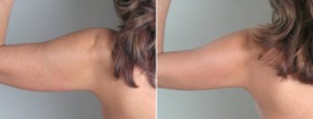 Upper Arm Rejuvenation Patient 2 – Liposuction