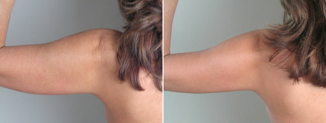 Upper Arm Rejuvenation Patient 2 – Liposuction