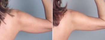 Upper Arm Rejuvenation Patient 2 – Liposuction