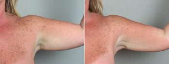Upper Arm Rejuvenation Patient 3 – Liposuction