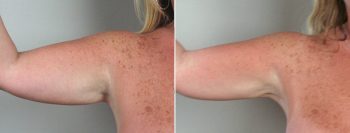Upper Arm Rejuvenation Patient 3 – Liposuction
