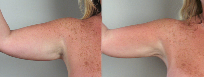 Upper Arm Rejuvenation Patient 3 – Liposuction