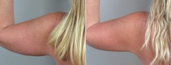 Upper Arm Rejuvenation Patient 3 – Liposuction