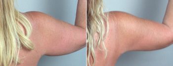Upper Arm Rejuvenation Patient 3 – Liposuction