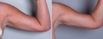 Upper Arm Rejuvenation Patient 4 – Liposuction