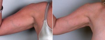 Upper Arm Rejuvenation Patient 4 – Liposuction