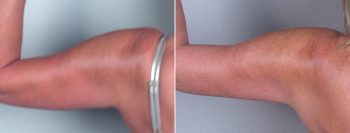 Upper Arm Rejuvenation Patient 4 – Liposuction