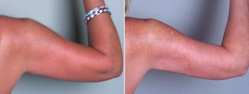 Upper Arm Rejuvenation Patient 4 – Liposuction