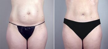 Mommy Makeover Patient 11