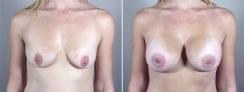 Mommy Makeover Patient 11