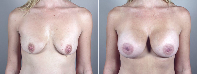 Mommy Makeover Patient 11