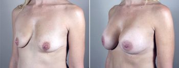 Mommy Makeover Patient 11