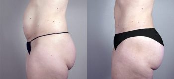 Mommy Makeover Patient 11