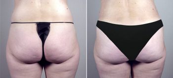 Mommy Makeover Patient 11