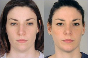 New Jersey Rhinoplasty