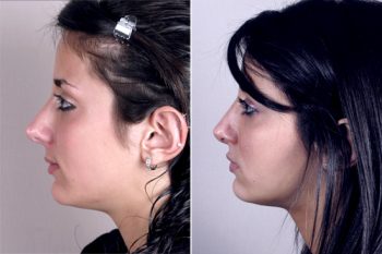 Rhinoplasty Patient 15