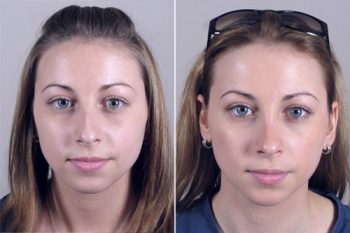 Rhinoplasty Patient 16