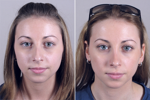 Rhinoplasty Patient 16