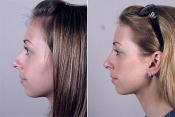 Rhinoplasty Patient 16
