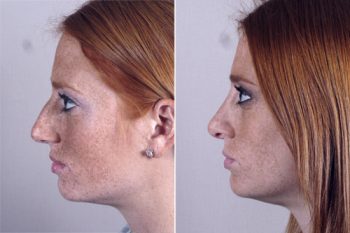 Rhinoplasty Patient 17