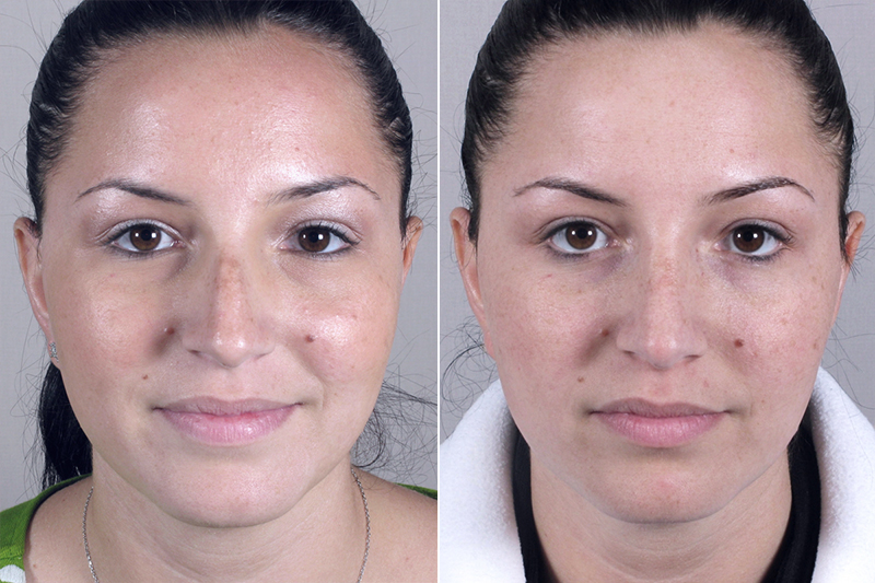 Rhinoplasty New Jersey Image