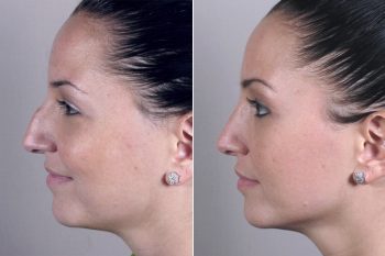 Rhinoplasty Patient 18