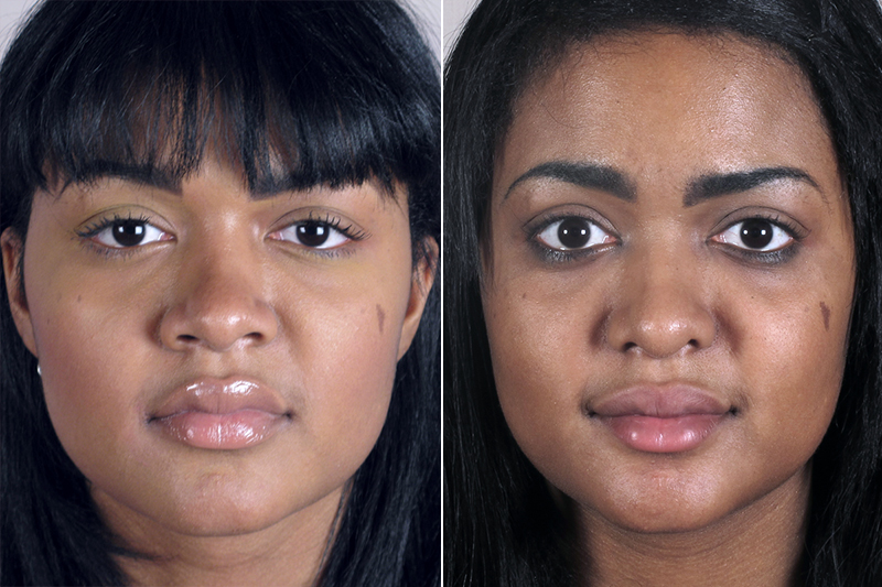 Rhinoplasty Patient 19