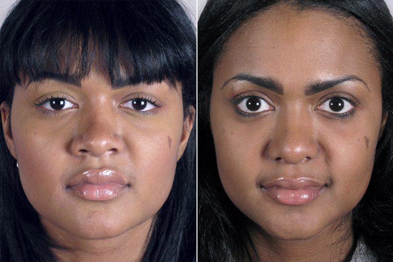 Before & After: Tiplasty with Nostril Reduction Rhinoplasty New Jersey Image
