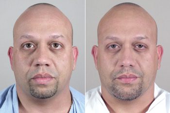 Male Rhinoplasty Patient 10
