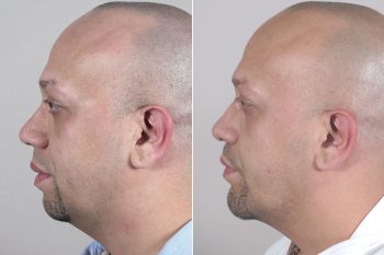 Male Rhinoplasty Patient 10