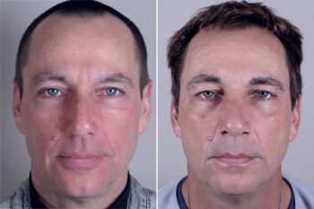 Male Rhinoplasty Patient 11