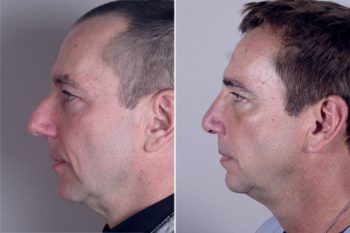 Male Rhinoplasty Patient 11