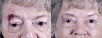 Skin Cancer Treatment Patient 14