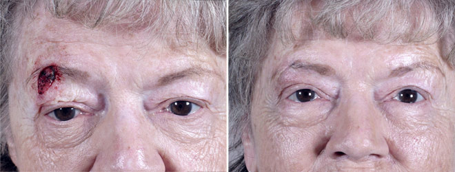 Skin Cancer Treatment Patient 14