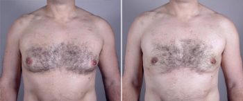 Gynecomastia Reduction Patient 12