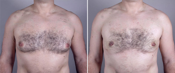 Gynecomastia Reduction Patient 12