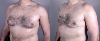 Gynecomastia Reduction Patient 12