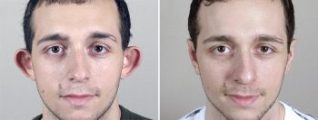 Otoplasty Patient 5