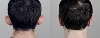 Otoplasty Patient 5