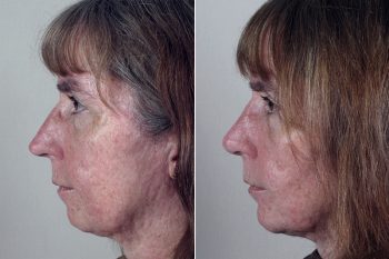 Rhinoplasty & Chin Implant Patient 20