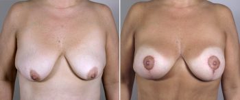 Mommy Makeover Patient 14