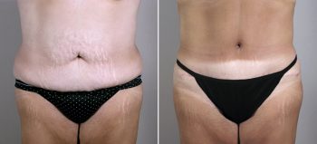 Mommy Makeover Patient 14